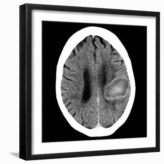 Haematoma, CT Scan-Du Cane Medical-Framed Photographic Print