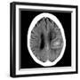 Haematoma, CT Scan-Du Cane Medical-Framed Photographic Print