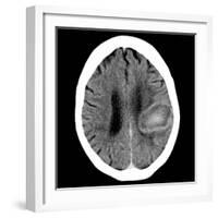 Haematoma, CT Scan-Du Cane Medical-Framed Photographic Print