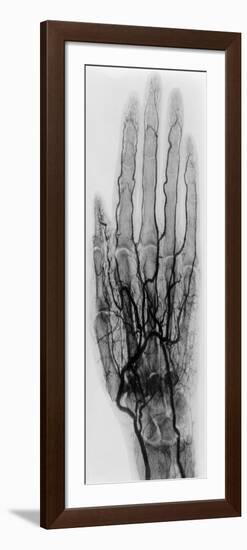 Hand Arteriogram-Science Source-Framed Premium Giclee Print