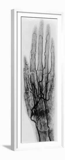 Hand Arteriogram-Science Source-Framed Premium Giclee Print