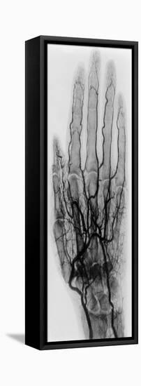 Hand Arteriogram-Science Source-Framed Stretched Canvas