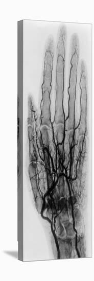 Hand Arteriogram-Science Source-Stretched Canvas