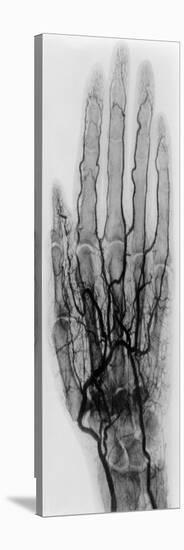 Hand Arteriogram-Science Source-Stretched Canvas