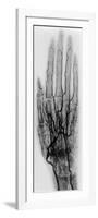 Hand Arteriogram-Science Source-Framed Giclee Print