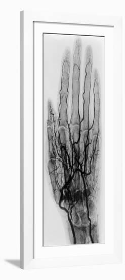 Hand Arteriogram-Science Source-Framed Giclee Print