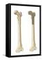 Head of Femur Fracture-null-Framed Stretched Canvas