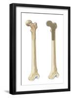 Head of Femur Fracture-null-Framed Art Print