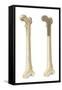 Head of Femur Fracture-null-Framed Stretched Canvas