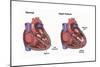 Healthy Heart vs. Heart Failure-Spencer Sutton-Mounted Premium Giclee Print