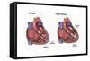 Healthy Heart vs. Heart Failure-Spencer Sutton-Framed Stretched Canvas
