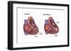 Healthy Heart vs. Heart Failure-Spencer Sutton-Framed Art Print