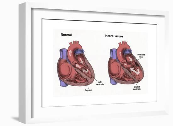 Healthy Heart vs. Heart Failure-Spencer Sutton-Framed Art Print