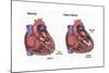 Healthy Heart vs. Heart Failure-Spencer Sutton-Mounted Art Print