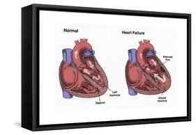 Healthy Heart vs. Heart Failure-Spencer Sutton-Framed Stretched Canvas