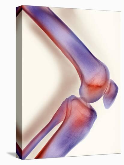 Healthy Knee, X-ray-Science Photo Library-Stretched Canvas