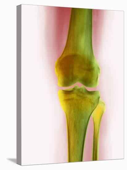 Healthy Knee, X-ray-Science Photo Library-Stretched Canvas