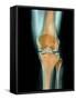 Healthy Knee, X-ray-Science Photo Library-Framed Stretched Canvas