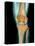 Healthy Knee, X-ray-Science Photo Library-Stretched Canvas