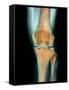 Healthy Knee, X-ray-Science Photo Library-Framed Stretched Canvas