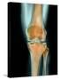 Healthy Knee, X-ray-Science Photo Library-Stretched Canvas