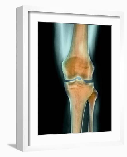 Healthy Knee, X-ray-Science Photo Library-Framed Photographic Print