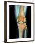 Healthy Knee, X-ray-Science Photo Library-Framed Photographic Print