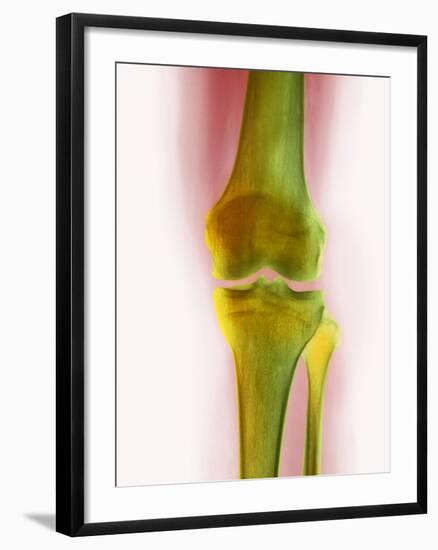 Healthy Knee, X-ray-Science Photo Library-Framed Photographic Print