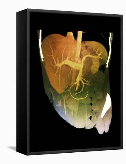 Healthy Liver, CT Scan-ZEPHYR-Framed Stretched Canvas