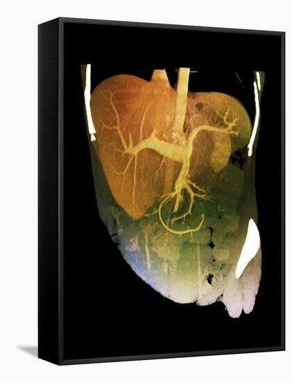 Healthy Liver, CT Scan-ZEPHYR-Framed Stretched Canvas