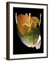 Healthy Liver, CT Scan-ZEPHYR-Framed Photographic Print