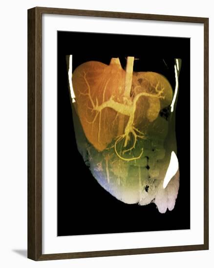 Healthy Liver, CT Scan-ZEPHYR-Framed Photographic Print