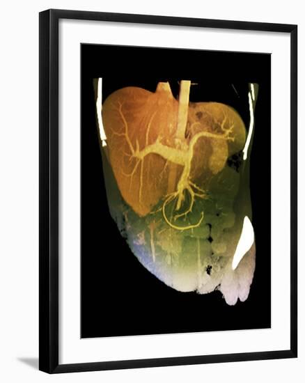 Healthy Liver, CT Scan-ZEPHYR-Framed Photographic Print