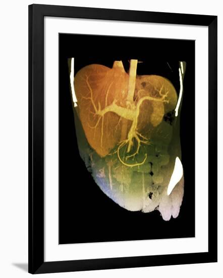 Healthy Liver, CT Scan-ZEPHYR-Framed Photographic Print