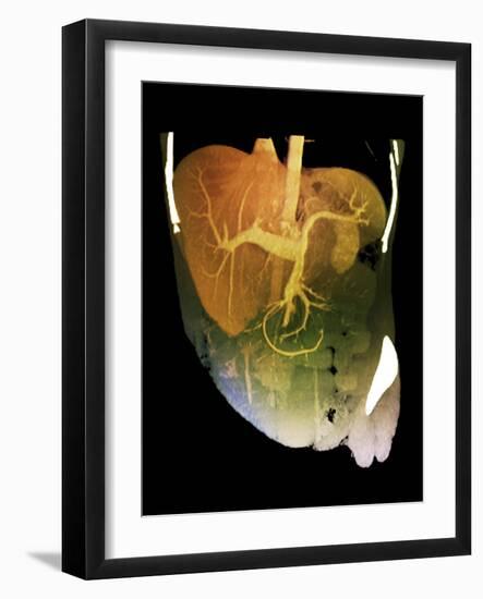 Healthy Liver, CT Scan-ZEPHYR-Framed Photographic Print