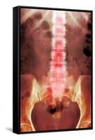 Healthy Lower Spine, X-ray-Du Cane Medical-Framed Stretched Canvas