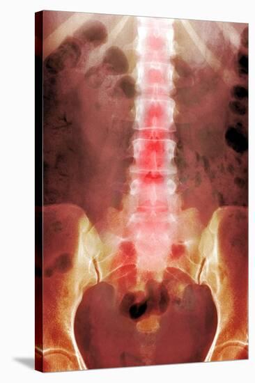 Healthy Lower Spine, X-ray-Du Cane Medical-Stretched Canvas