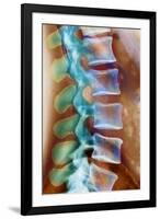 Healthy Lower Spine, X-ray-Science Photo Library-Framed Photographic Print