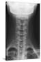 Healthy Spine of the Neck, X-ray'-Du Cane Medical-Stretched Canvas