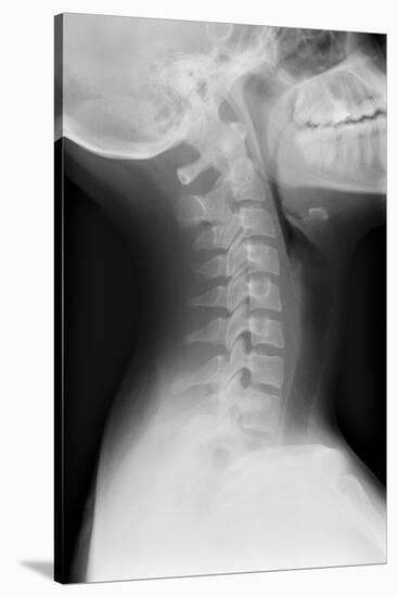 Healthy Spine of the Neck, X-ray'-Du Cane Medical-Stretched Canvas