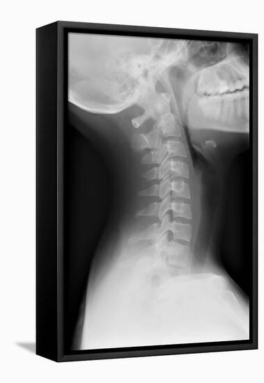 Healthy Spine of the Neck, X-ray'-Du Cane Medical-Framed Stretched Canvas