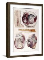 Heart, Aneurysm, Illustration, 1838-Science Source-Framed Giclee Print