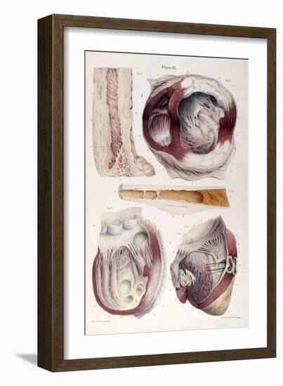 Heart, Aneurysm, Illustration, 1838-Science Source-Framed Giclee Print