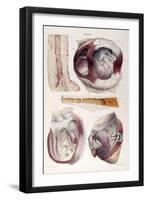 Heart, Aneurysm, Illustration, 1838-Science Source-Framed Giclee Print