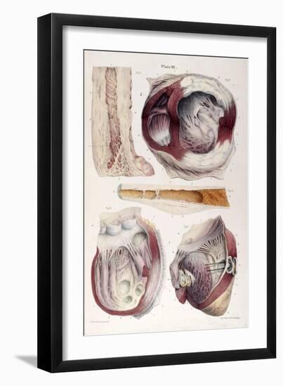 Heart, Aneurysm, Illustration, 1838-Science Source-Framed Giclee Print