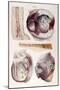 Heart, Aneurysm, Illustration, 1838-Science Source-Mounted Giclee Print