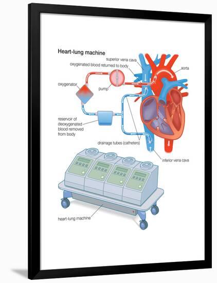 Heart-Lung Machine-Encyclopaedia Britannica-Framed Poster