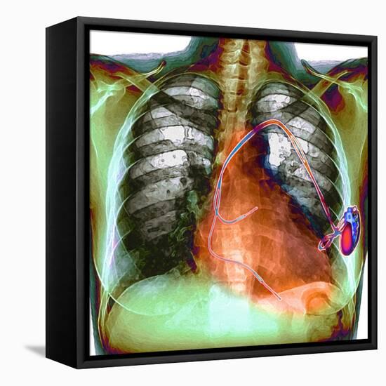 Heart Pacemaker, X-ray-Du Cane Medical-Framed Stretched Canvas