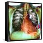 Heart Pacemaker, X-ray-Du Cane Medical-Framed Stretched Canvas