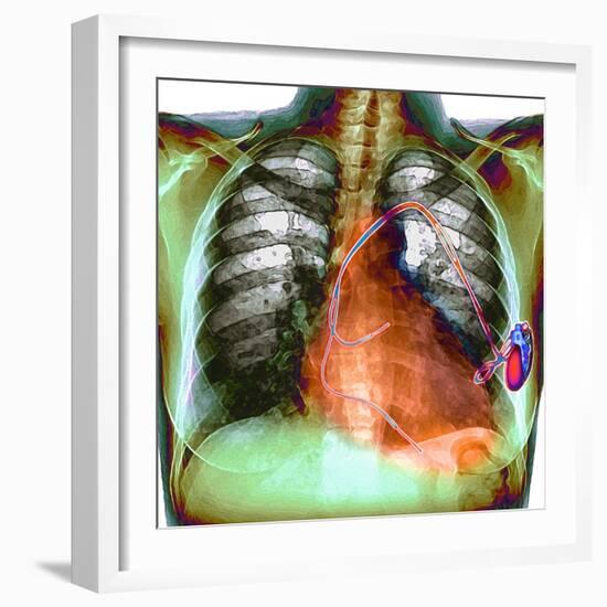 Heart Pacemaker, X-ray-Du Cane Medical-Framed Premium Photographic Print